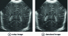Figure 15 - Denoising an ultrasound image for K = 3