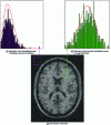 Figure 5 - MR image (noisy) of brain anatomy and two probability density estimates, based on SNR of the area of interest