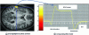 Figure 6 - fMRI: highlighting the BOLD response