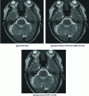 Figure 9 - Denoising an MR image of the brain (axial section)