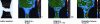 Figure 10 - Subtracting the two thermal images gives the intrinsic dissipation, indicative of the damage to the leather between the two loading levels [27].