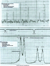 Figure 7 - Differences in the nature of noise observed when recording spectra using two different processes