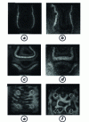 Figure 12 - Shearography images of a potted honeycomb panel with and without bonding defects for three excitation frequencies of 1,700 Hz, 3,200 Hz and 22 kHz; dotted circles indicate defect location.