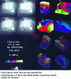 Figure 26 - Interferometric cinehologram of a car door that has just been slammed and digital processing of interferograms