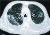 Figure 6 - X-ray scan of a patient's rib cage. The anatomical structure is clearly visible: spinal bones and ribs (white), fatty tissue (light grey) and lungs (dark grey).