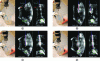 Figure 16 - Needle insertion into a gel performed by visual servoing under the feedback of a 3D ultrasound probe, where the control is the displacement of the base of the needle carried by the robot [144], [145]. The four figures show needle advancement during insertion (from (a) to (d)) and present an external view and two orthogonal ultrasound planes containing the needle. The target is the green circle, the needle detected in the images is in blue and the red line shows the trace of the needle in the tissue. The gel is moved manually from right to left and then from left to right during insertion (reproduced by kind permission of A. Krupa).