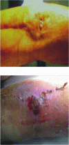 Figure 12 - Allergies to metals in orthopedic prostheses (SOFCOT 2006 – F. Délépine, H. Corneville and G. Délépine)