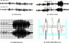 Figure 25 - Instability phenomena and lateral accelerations on bogie 1 and 2 :
normal running, “nervous” running but still stable, instability phenomena,
wheelset guiding stiffness Cx/Cy