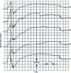 Figure 9 - Electric field variations measured on the fuselage of the Transall C160 and caused by the initiation of a lightning strike by the aircraft.