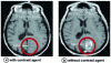 Figure 7 - Comparison of MRI images of the same brain with and without contrast agent