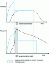 Figure 9 - Cylinder and cavity pressure trends: normal and excessive screw travels