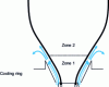 Figure 10 - Single flow ring operating principle [7].