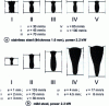 Figure 15 - Laser welding profiles