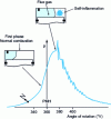 Figure 28 - Pressure diagram with intense clicking [2]