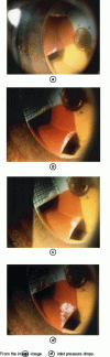 Figure 32 - Development of cavitation pocket as inlet pressure drops (stroboscopy)