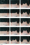 Figure 15 - Stage in the formation of a thread in 42 CrMo 4 steel tapped by deformation