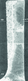 Figure 38 - Turbine distributor: repair of worn bearing face using RBD sinter