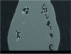 Figure 6 - Underlying porosity (Invar SLM sample)