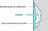 Figure 12 - Injection of hollow or cavernous areas