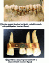 Figure 17 - Implantology in ancient Egypt [96] [97]