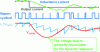 Figure 18 - Illustration of converter behavior during a negative current transient, in the case of a current loop.