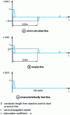 Figure 4 - End-of-line discontinuity echograms