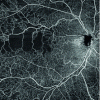 Figure 16 - Angiographic OCT image revealing microvascularization of a retina (12 x 12 mm) (source: Carl Zeiss Meditec)