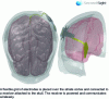 Figure 3 - Orion implant by Second Sight37