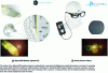 Figure 5 - Subretinal implants (adapted from Pixium-Vision and Retina Implant AG)