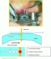 Figure 22 - Illustration and principle of femtosecond impulse corneal surgery (LASIK) [38].