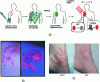 Figure 2 - (a) Schematic principle of a PDT treatment (illustration taken from reference [12]) (b) tumor after accumulation of a porphyrin photosensitizer, seen under normal light (left) and UV lamp (right; brightness is due to porphyrin fluorescence) (c) Bowen's disease patient before and after PDT treatment (illlustrations taken from reference [23])