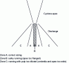 Figure 3 - Influence of apex diameter on cyclone subverse appearance