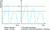 Figure 32 - Principle of three-stage treatment with intercritical quenching between quenching and conventional tempering [37]