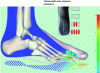 Figure 16 - Pain-relieving forefoot stepping zones to escape ulcerated heel pain