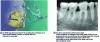 Figure 11 - Rinn angulator for intraoral teleradiography (TIB) and retroalveolar cliché centered on the distal root of a mandibular molar