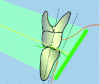 Figure 12 - Retrocoronal view. Diagram, in the mesio-distal direction, showing the placement of the sensor held by a tab by the patient in occlusion without maximum intercuspidation.