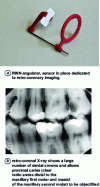 Figure 13 - Rinn angulator and retro-coronary images