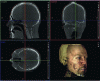 Figure 17 - Classic interface for volume imaging. This wide-field cone-beam image produced by the radiologist presents three orthogonal projections: axial reference, sagittal and frontal. A volume reconstruction with tegument simulation can complete the presentation (Source: Planméca).