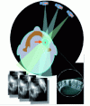 Figure 7 - Principle of CBCT exploration. For Cone Beam CT modalities, the source-sensor assembly (flat panel) rotates around a fixed point centered on the explored volume. Three elementary initial projections are shown here (usually 360), which will be used to reconstruct the axial section shown at bottom right.