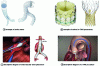 Figure 10 - Some examples of stents