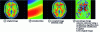 Figure 6 - Illustration of the effect of intensity bias on the estimation of brain atrophy (© F. Rousseau, ICube, 2013)