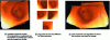 Figure 17 - Two cards constructed from the same gastroscopic sequence of some thirty images