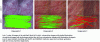 Figure 6 - Illustration of SURF's applicability to the detection of homologous points in white-light cystoscopy