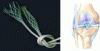 Figure 11 - High-density polyethylene braided materials for a ligament implant (Images: Cousin Biotech and Robson A.W.)