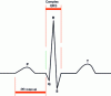 Figure 1 - Morphology of the normal electrocardiogram [6].