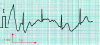 Figure 7 - Motion ECG obtained by wire-wound electrodes after 50 washes when walking at 3-4 km/h