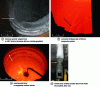 Figure 6 - Examples of surface corrosion by slags located above the metal bath