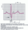 Figure 1 - Electrocardiogram appearance