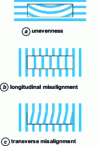 Figure 16 - The three types of error in the shape of a gauge block that can be observed by interferometry