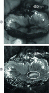 Figure 8 - Example of a cervical biopsy image at 450 nm a) intensity and b) degree of polarization. The white ellipse surrounds severe dysplasia [29].